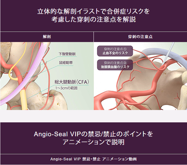 立体的な解剖イラストで合併症リスクを 考慮した穿刺の注意点を解説