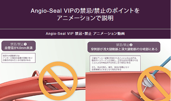 Angio-Seal VIPの禁忌/禁止のポイントを アニメーションで説明
