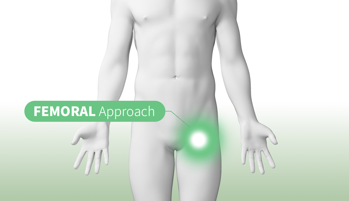 Femoralアプローチイメージ画像