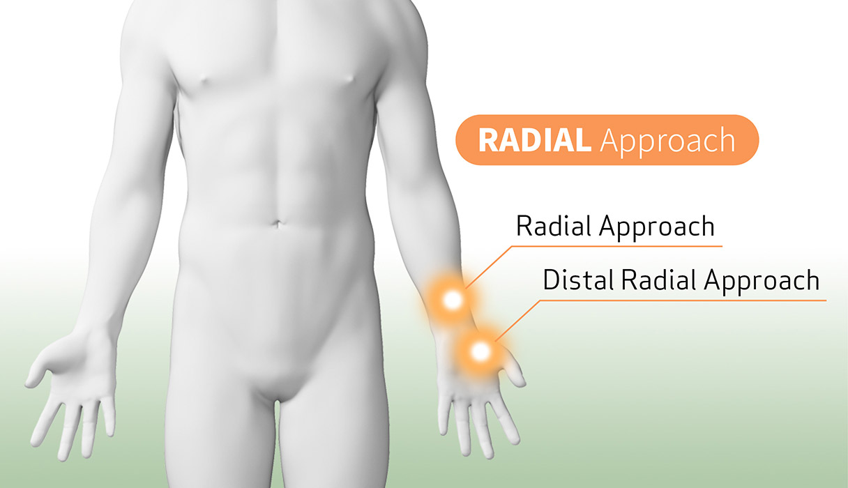 Radialアプローチイメージ画像